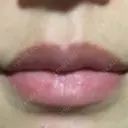 アートメイク（唇） Wクリニック 心斎橋院 AFTER サムネイル用