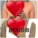 脂肪吸引（二の腕） アムルーズ美容外科クリニック 大阪院 DAY 32 サムネイル用