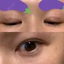 二重埋没 / 二重切開 宇都宮竹内クリニック DAY 97 サムネイル用