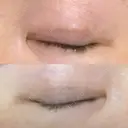 二重埋没 / 二重切開 宇都宮竹内クリニック AFTER サムネイル用