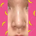 鼻尖形成（切開） / 小鼻縮小（切開） / 軟骨移植 / 鼻孔縁挙上 / 鼻尖縮小 ヴェリテクリニック 大阪院 DAY 14 サムネイル用