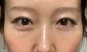 クマ治療 / 下まぶたたるみ取り / 下まぶたの脂肪取り セオリークリニック DAY 22 サムネイル用