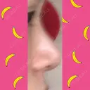 鼻尖形成（切開） / 小鼻縮小（切開） / 軟骨移植 / 鼻孔縁挙上 / 鼻尖縮小 ヴェリテクリニック 大阪院 DAY 14 サムネイル用