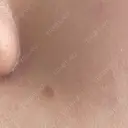 ほくろ・いぼ切除（肌） 大山皮膚科 DAY 21 サムネイル用