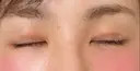 二重切開 郡山タウン形成外科クリニック DAY 81 サムネイル用