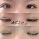 目頭切開 / 眼瞼下垂（切開） 白山クリニック 大分 DAY 29 サムネイル用