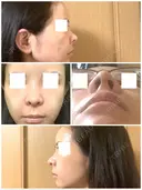 鼻尖形成（切開） / 鼻中隔延長（切開） / 軟骨移植 eクリニック 金沢本院 DAY 14 サムネイル用