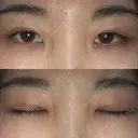 二重切開 / 眼瞼下垂（切開） ブリスクリニック形成外科・美容外科・美容皮膚科 福岡 DAY 59 サムネイル用