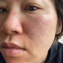 ダーマペン / 毛穴洗浄（ハイドラフェイシャルなど） B-LINE CLINIC 池袋院 DAY 1 サムネイル用