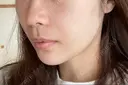 あごプロテーゼ / 鼻翼基部形成（貴族手術） ジョウクリニック 大阪院 DAY 16 サムネイル用