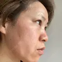ダーマペン / 毛穴洗浄（ハイドラフェイシャルなど） B-LINE CLINIC 池袋院 DAY 2 サムネイル用