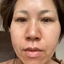 ダーマペン / 毛穴洗浄（ハイドラフェイシャルなど） B-LINE CLINIC 池袋院 DAY 2 サムネイル用