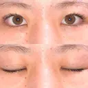 二重埋没 R.O.clinic DAY 189 サムネイル用