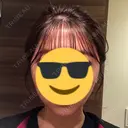 糸リフト / 脂肪吸引（顔） / ボトックス（あご） WOM CLINIC GINZA （ワム クリニック ギンザ） DAY 100 サムネイル用