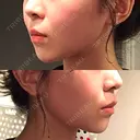 糸リフト / 脂肪吸引（顔） / ボトックス（あご） WOM CLINIC GINZA （ワム クリニック ギンザ） DAY 100 サムネイル用