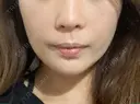 あごプロテーゼ / 鼻翼基部形成（貴族手術） ジョウクリニック 大阪院 DAY 18 サムネイル用