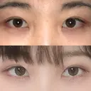 二重切開 / 眼瞼下垂（切開） ブリスクリニック形成外科・美容外科・美容皮膚科 福岡 DAY 62 サムネイル用