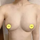豊胸（脂肪注入） Mods Clinic（モッズクリニック） 東京院 DAY 31 サムネイル用