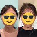 糸リフト / 脂肪吸引（顔） / ボトックス（あご） WOM CLINIC GINZA （ワム クリニック ギンザ） DAY 101 サムネイル用