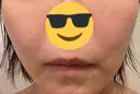 シミ取りレーザー PICO BEAUTY CLINIC DAY 1 サムネイル用
