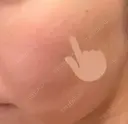 シミ取りレーザー PICO BEAUTY CLINIC DAY 1 サムネイル用