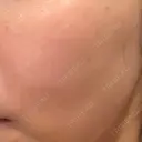 シミ取りレーザー PICO BEAUTY CLINIC DAY 1 サムネイル用