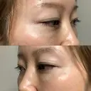 クマ治療 / 下まぶたたるみ取り / 下まぶたの脂肪取り セオリークリニック DAY 28 サムネイル用