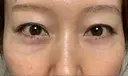 クマ治療 / 下まぶたたるみ取り / 下まぶたの脂肪取り セオリークリニック DAY 28 サムネイル用