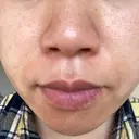 ダーマペン / 毛穴洗浄（ハイドラフェイシャルなど） B-LINE CLINIC 池袋院 AFTER サムネイル用