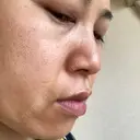 ダーマペン / 毛穴洗浄（ハイドラフェイシャルなど） B-LINE CLINIC 池袋院 DAY 5 サムネイル用