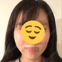 脂肪注入（輪郭） 湘南美容クリニック 新潟院 DAY 14 サムネイル用