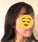 脂肪注入（輪郭） 湘南美容クリニック 新潟院 DAY 14 サムネイル用