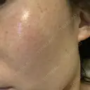 美肌レーザー / シミ取りレーザー たかはし形成外科･美容外科  DAY 6 サムネイル用