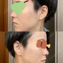 ダーマペン AURORA CLINIC（オーロラクリニック）新宿院 DAY 3 サムネイル用