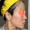 ダーマペン AURORA CLINIC（オーロラクリニック）新宿院 DAY 3 サムネイル用