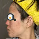 ダーマペン AURORA CLINIC（オーロラクリニック）新宿院 DAY 3 サムネイル用