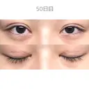 二重切開 / 目頭切開 / 上まぶたたるみ取り サラ美容外科 DAY 50 サムネイル用