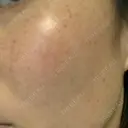 美肌レーザー / シミ取りレーザー たかはし形成外科･美容外科  DAY 7 サムネイル用