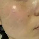 美肌レーザー / シミ取りレーザー たかはし形成外科･美容外科  DAY 7 サムネイル用