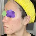 ダーマペン AURORA CLINIC（オーロラクリニック）新宿院 DAY 4 サムネイル用