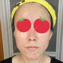 ダーマペン AURORA CLINIC（オーロラクリニック）新宿院 DAY 4 サムネイル用