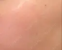 シミ取りレーザー PICO BEAUTY CLINIC AFTER サムネイル用