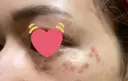 シミ取りレーザー / ピコレーザートーニング（美白・肝斑） ルラ美容クリニック 高田馬場院 DAY 4 サムネイル用