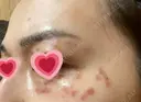シミ取りレーザー / ピコレーザートーニング（美白・肝斑） ルラ美容クリニック 高田馬場院 DAY 5 サムネイル用