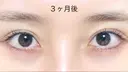 二重切開 / 上まぶたたるみ取り R.O.clinic DAY 90 サムネイル用