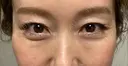 クマ治療 / 下まぶたたるみ取り / 下まぶたの脂肪取り セオリークリニック DAY 31 サムネイル用