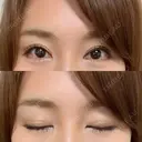 二重切開 / 眼瞼下垂（切開） / 上まぶたたるみ取り 湘南美容クリニック 新宿南口院 DAY 212 サムネイル用