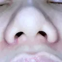 小鼻縮小（切開） ながしまクリニック DAY 12 サムネイル用