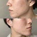 ダーマペン AURORA CLINIC（オーロラクリニック）新宿院 DAY 7 サムネイル用