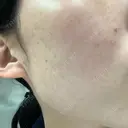 美肌レーザー / シミ取りレーザー たかはし形成外科･美容外科  DAY 11 サムネイル用